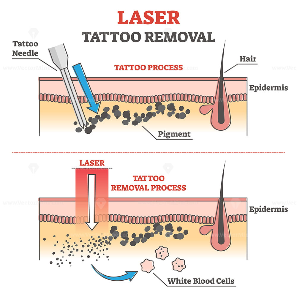 Bildet viser hvordan laseren fjerner blekket i huden hos TBL Medical